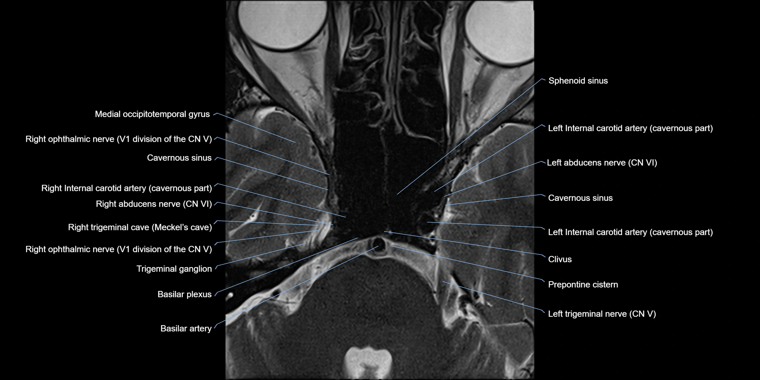 MRI cavernous sinus axial cross sectional 3T anatomy image-img-11001-00008.webp